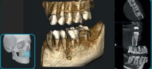 FOB 5X5